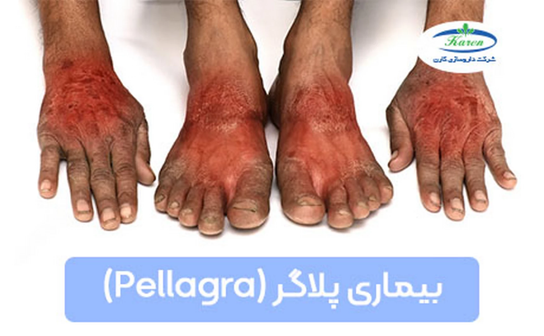 تصویر یک فرد با بیماری پلاگر